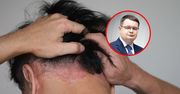 Skóra głowy pod lupą. Dermatolog obala mity