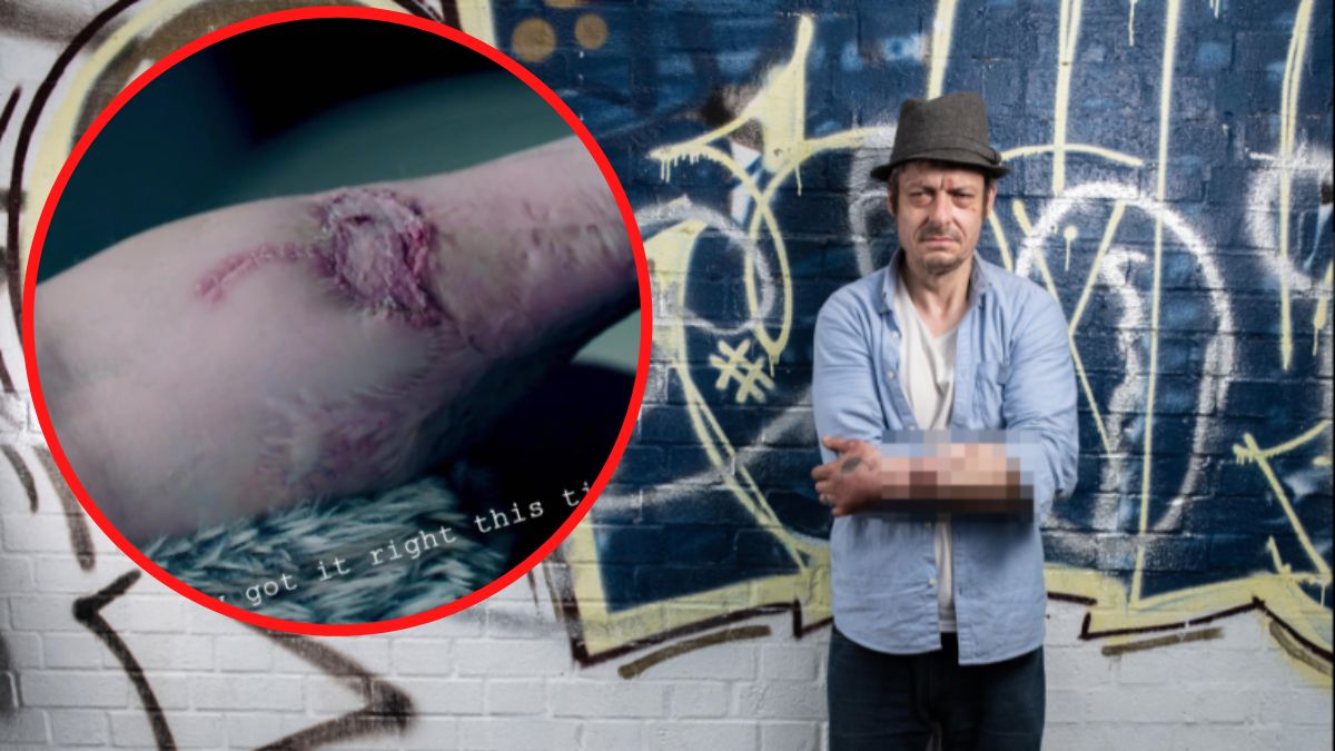 Przez sepsę stracił penisa. Przez sześć lat żył z wszczepionym na przedramię przyrodzeniem