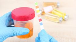 Kreatynina w moczu - cel badania i jego wykonanie, wyniki prawidłowe, wyniki nieprawidłowe