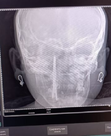 Lekarze usunęli nożyczki z czaszki dziecka