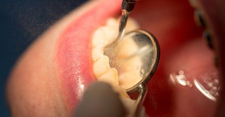 Kiedy boisz się dentysty, masz więcej ubytków
