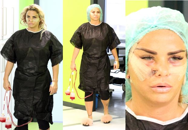 Zmasakrowana twarz Katie Price straszy po TRZECIEJ serii operacji plastycznych (FOTO)