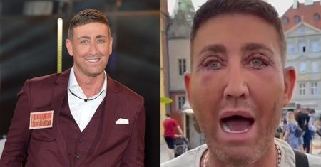 Gwiazdor brytyjskiego "X Factora" przyleciał do Polski na lifting powiek. Pokazał KRWAWE efekty (WIDEO)