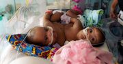 Urodziły się zrośnięte tułowiem. Chirurgom udało się je rozdzielić