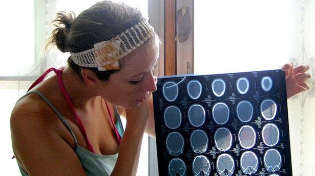 Syndrom fantomowych wibracji - komórki wpływają na układ nerwowy 1