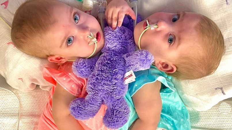 Dwa lata temu przeszły operację rozdzielenia. Tak bliźniaczki wyglądają dzisiaj