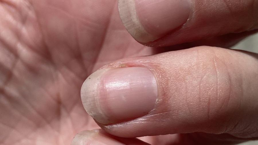 Zwróć uwagę na wygląd paznokci. Ponad 80 proc. osób z marskością wątroby zauważa ten objaw