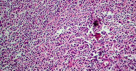 Chłoniak Hodgkina (ziarnica złośliwa) - przyczyny, objawy, diagnostyka, leczenie, rokowania