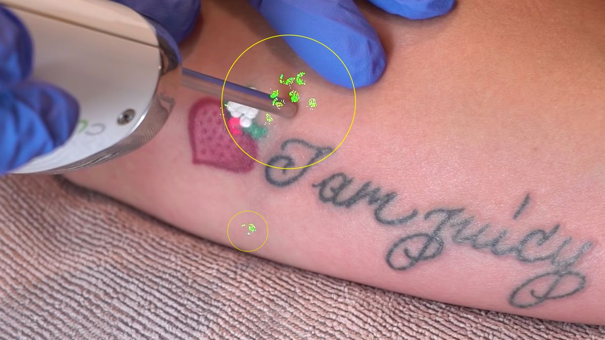 Laser wypalił nie tylko tatuaż. Zobacz, jak łatwo zniszczyć aparat 1