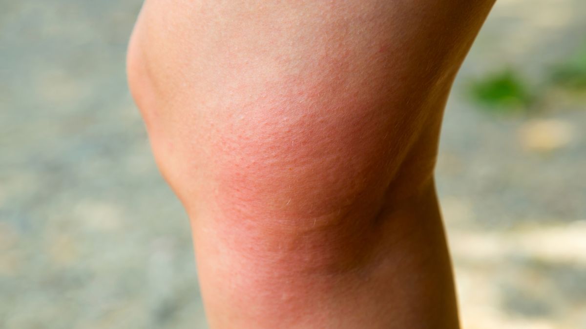 Rumień alergiczny może objawiać się czerwonymi plamami i swędzeniem