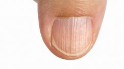 O czym świadczą pionowe bruzdy na paznokciach? 
