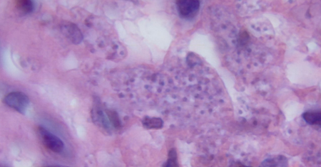 Leishmania – co to jest, objawy, leczenie