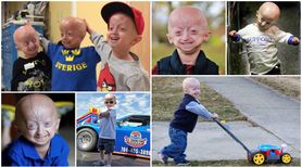 Progeria - przedwczesna starość