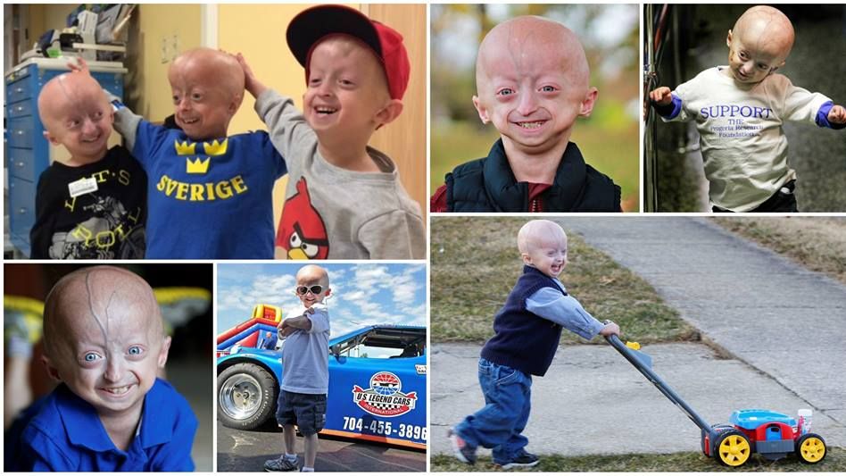 Progeria - przedwczesna starość