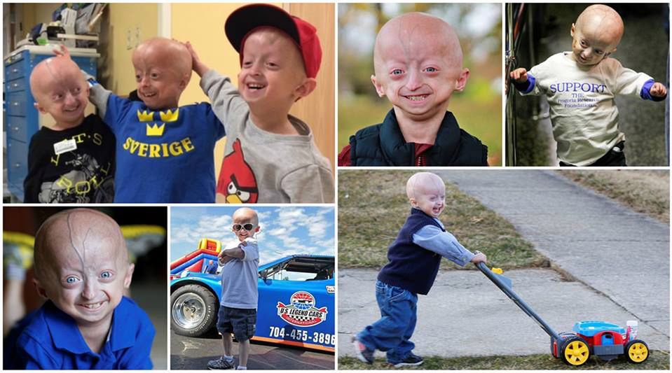 Progeria - przedwczesna starość