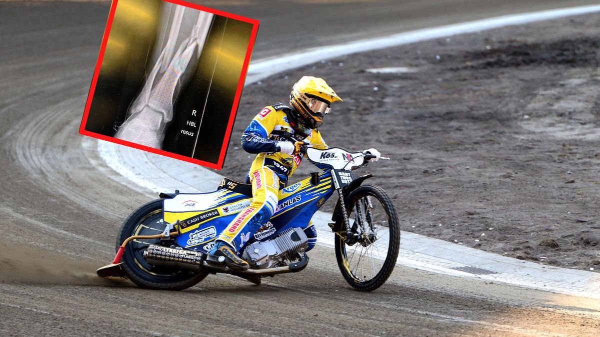 Zdjęcie okładkowe artykułu: WP SportoweFakty / Dawid Lis / Anders Thomsen złamał dwie kości podczas GP Challenge / Zdjęcie RTG na podstawie Instagram.com/krzysztofsudak