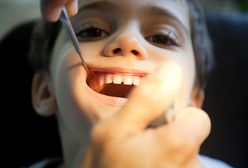 Czarne zęby u dzieci to plaga
