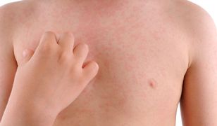 Kontrowersyjny zakład dotyczący odry. Biolog musi zapłacić 100 tys. euro