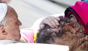 Papież ucałował zdeformowaną twarz chorego mężczyzny