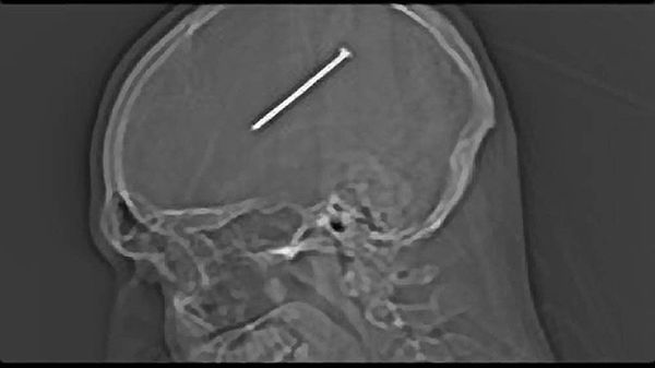 Zdjęcie rentgenowskie głowy Dantego Autullo