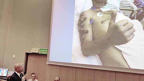 Kierownik zespołu operującego prof. Adam Maciejewski podczas konferencji prasowej nt. pierwszego przeprowadzonego w Polsce przeszczepu twarzy