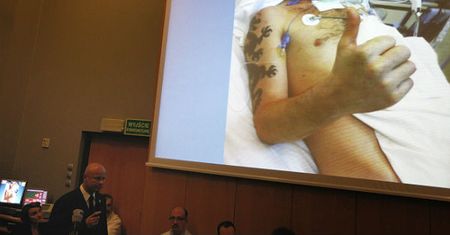 Sukces Polaków. Pierwsza taka transplantacja twarzy na świecie