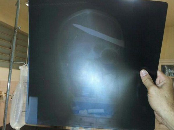 Lekarze w Brazylii usunęli z głowy mężczyzny nóż