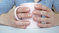 Pojawiają się na paznokciach. Lekarka wyjaśnia, kiedy wskazują na wyniszczone nerki