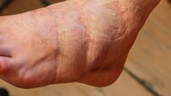 Ten kolor zauważysz na nogach. Znak, że cholesterol zapycha tętnice