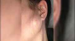 Zmiana na policzku okazała się objawem raka 