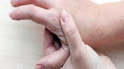 Domowe sposoby na pozbycie się kurzajek