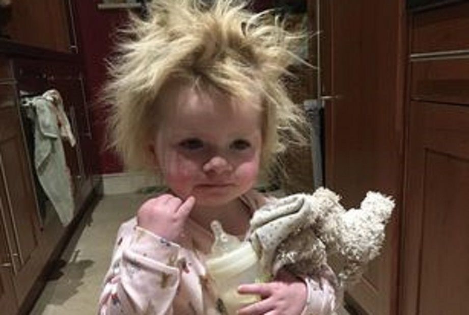 Rosie ma syndrom włosów niedających się uczesać