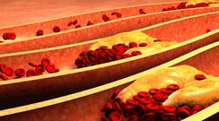 Masz wysoki cholesterol? Zobacz jak wpływa na twoje ciało