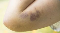 Choroby, których objawem są siniaki 