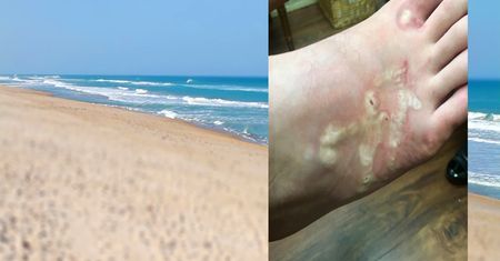 Zaraził się pasożytami na plaży