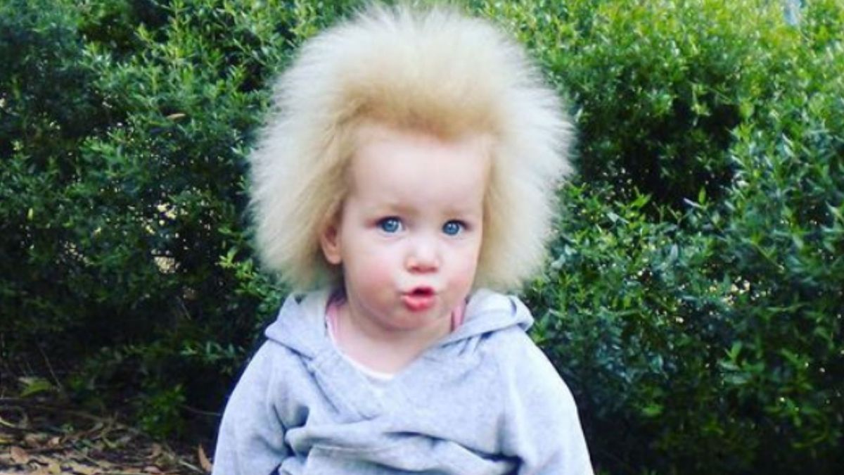 Dziewczynka z zespołem włosów niedających się uczesać