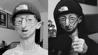 Nie żyje 28-letni influencer. Michiel Vandeweert zmagał się z rzadką chorobą genetyczną