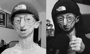 Nie żyje 28-letni influencer. Zmagał się z rzadką chorobą genetyczną
