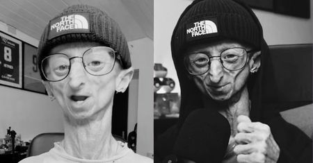 Nie żyje 28-letni influencer. Zmagał się z rzadką chorobą genetyczną