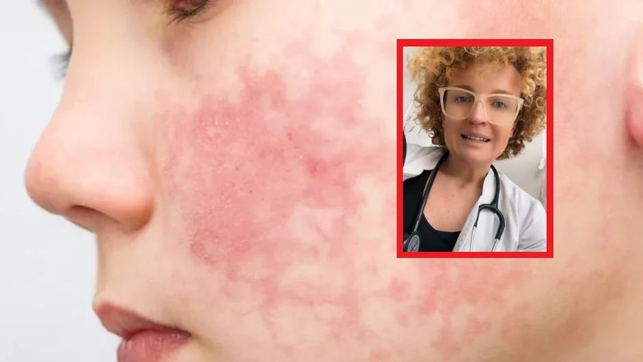 Czerwone policzki u dziecka są objawem choroby. Najczęściej atakuje przedszkolaków