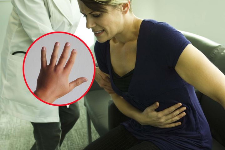 Zwróć uwagę na dłonie, to znak, że choroba jest zaawansowana