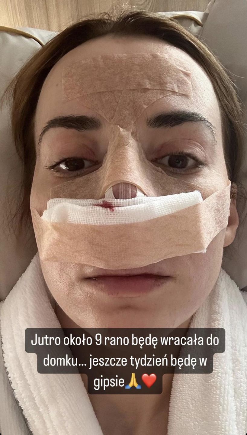 Marianna Schreiber przeszła operację nosa