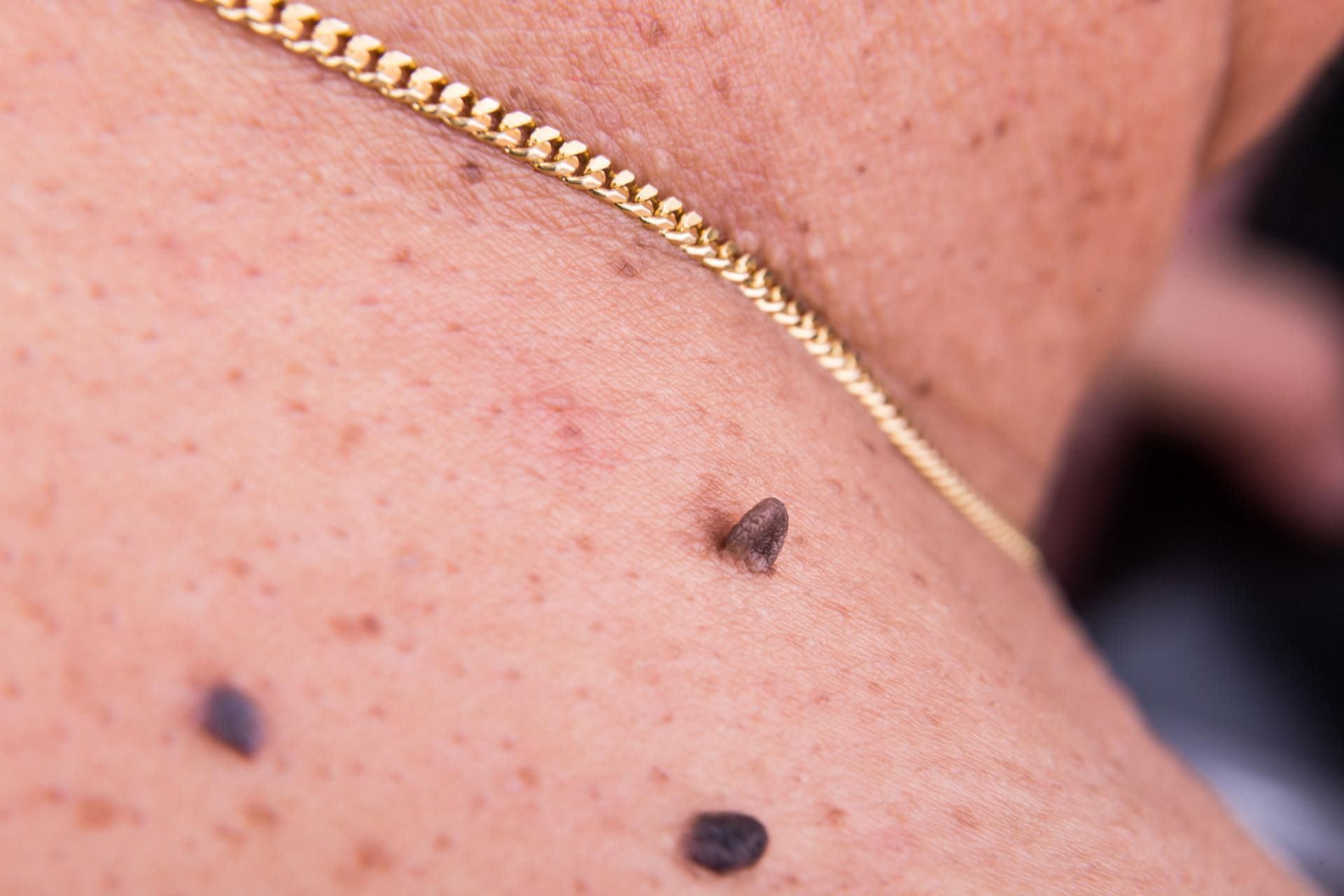 123rf.com Niektóre przebarwienia skóry szyi mogą być objawem nowotworów