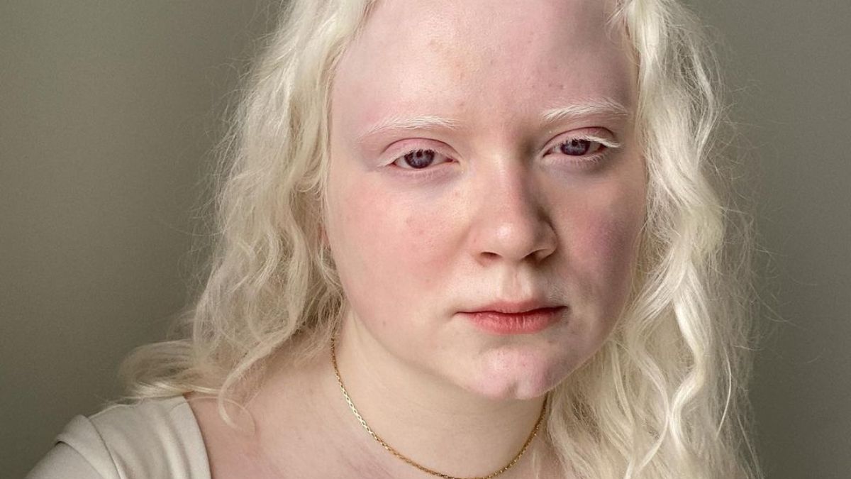 Oceanne w mediach społecznościowych edukuje społeczeństwo na temat albinizmu