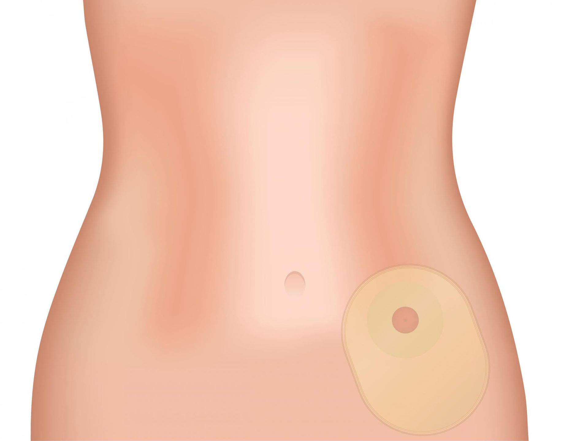 Przetoka to sztuczne połączenie np: jelita z powierzchnią brzucha