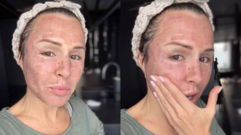 Blanka Lipińska prezentuje zmasakrowane laserem lico