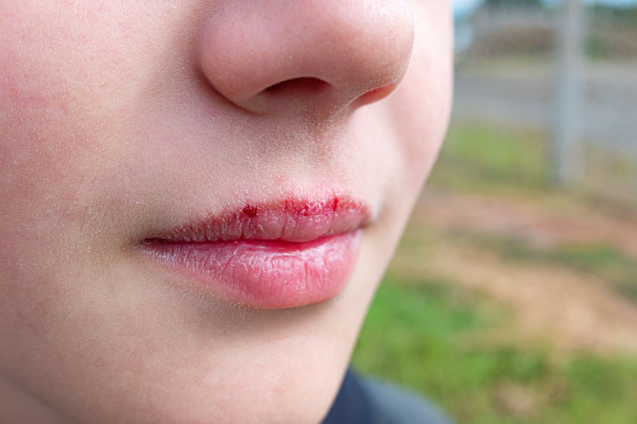 Chapped lips relief: Honey and sugar remedies for winter