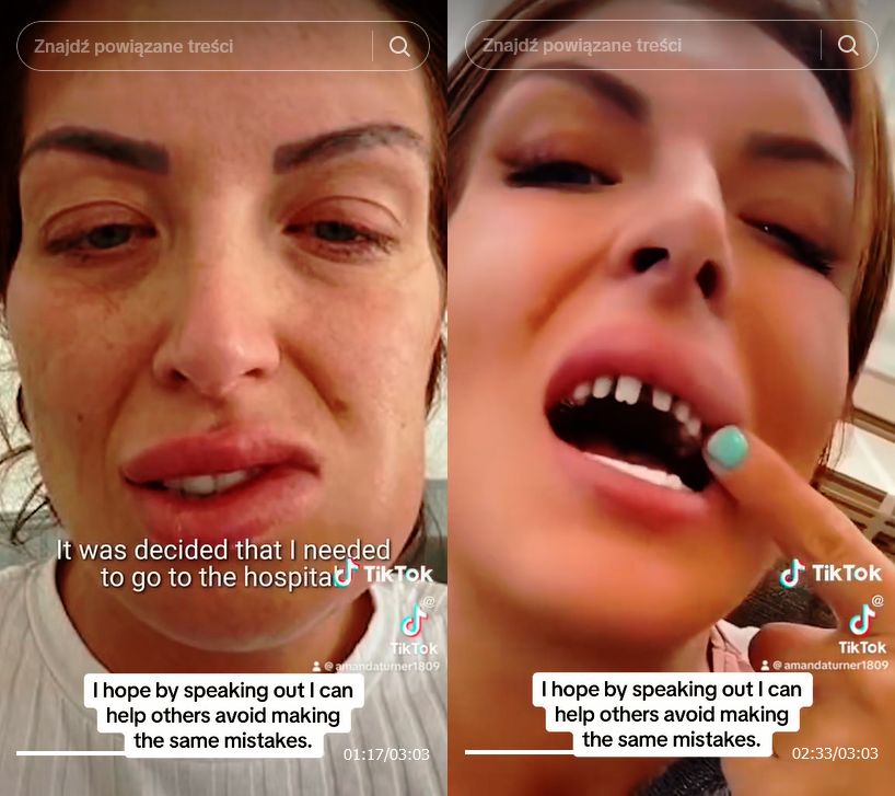 Tiktokerka Amanda Turner zafundowała sobie "tureckie zęby"