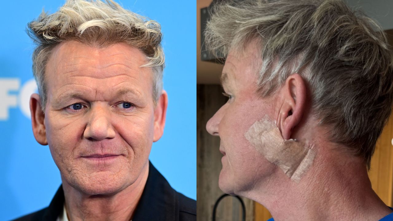 Gordon Ramsay ujawnił, że miał raka skóry. Żartował: "To nie jest lifting twarzy"