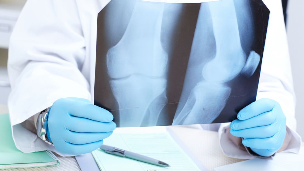 Objawy nowotworu kości